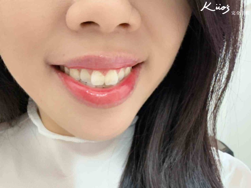 【隱形牙套】Zenyum 綻雅隱形牙套價格、戴多久、有用嗎? 23 隱形牙套、隱形牙套推薦